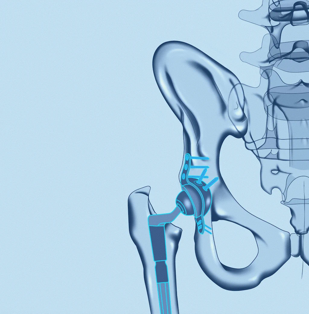 revisione protesi anca